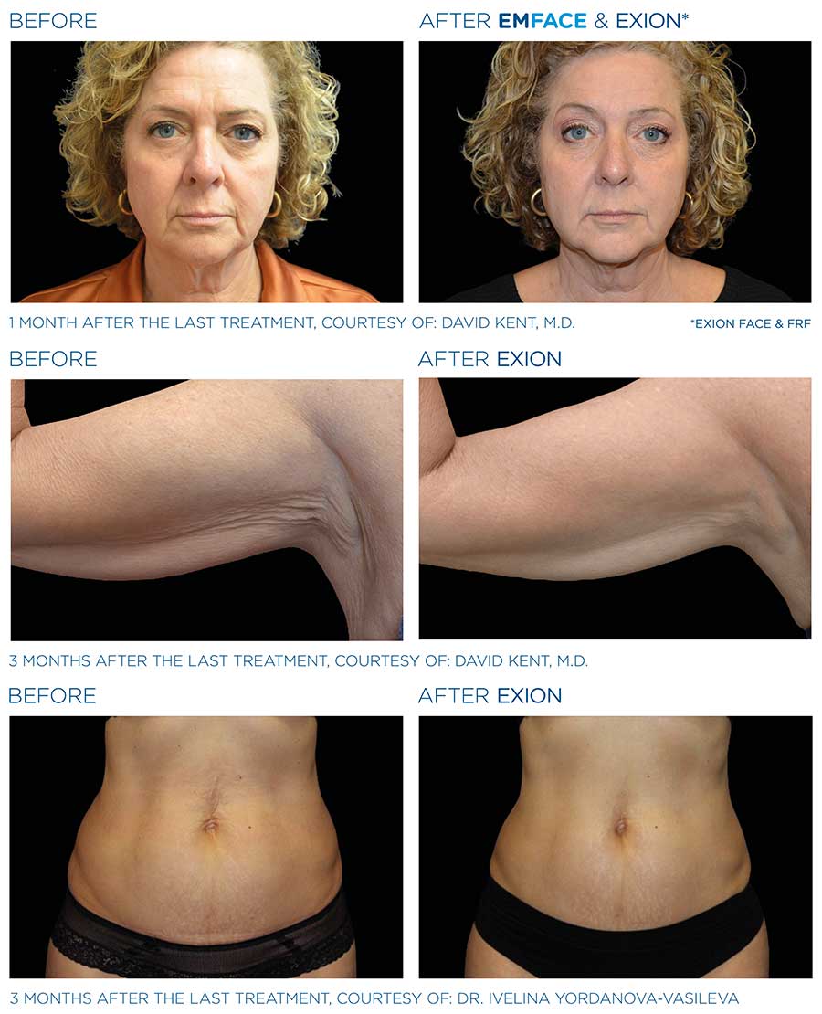 Exion RF Microneedling Treatment Tucson