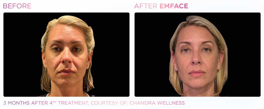 EMFace Microneedling Treatment Tucson